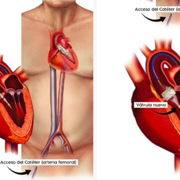 vena2 Épica historia de una mexicana: Reemplazo de Válvula Aórtica por Catéter